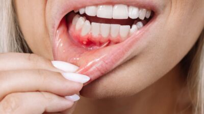 Periodontite: como a cannabis medicinal pode ajudar