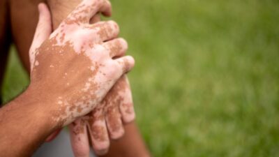 Vitiligo: como a cannabis medicinal pode ajudar quem tem manchas brancas na pele