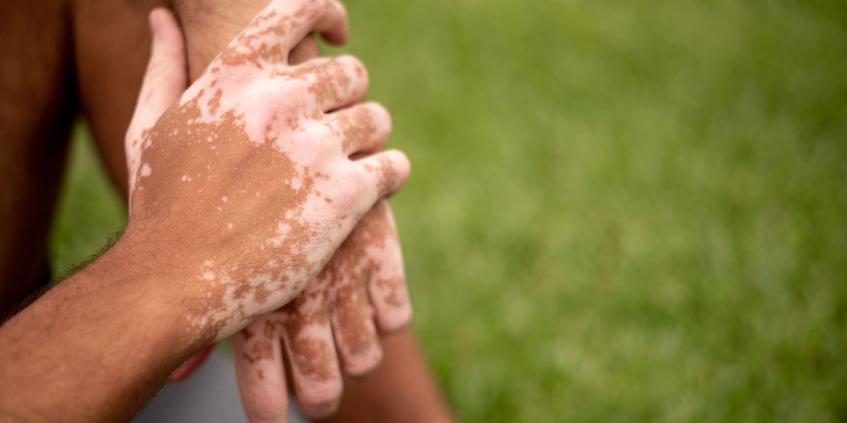 Vitiligo: como a cannabis medicinal pode ajudar quem tem manchas brancas na pele