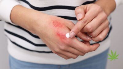 Fitocanabinoides como aliado para cicatrização de feridas 