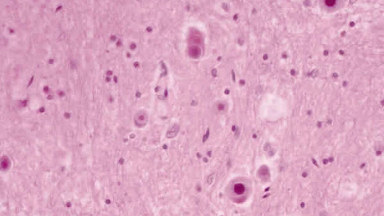 Doença de Lafora: CBD demonstra eficácia no tratamento de casos graves desta epilepsia rara